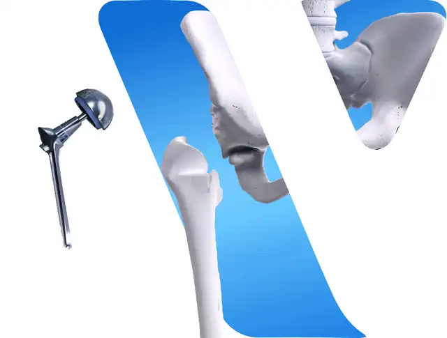 Animated illustration of medical implant finishing